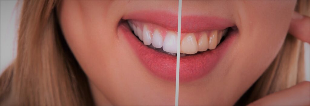 Blanqueamiento dental