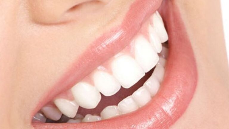 Sonrisa despues de blanqueamiento